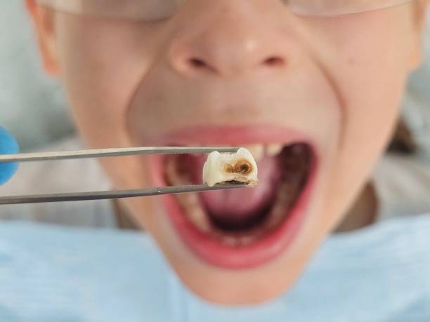Urgent Tooth Repair in OH